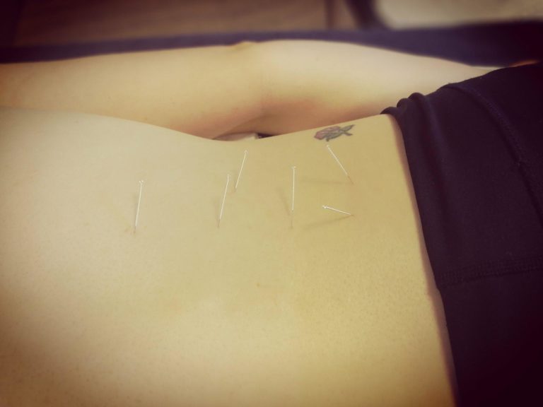 Dry Needling in Chippenham